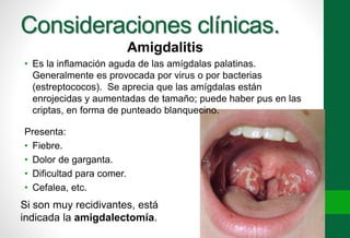 Consideraciones clínicas. 
Amigdalitis 
• Es la inflamación aguda de las amígdalas palatinas. 
Generalmente es provocada por virus o por bacterias 
(estreptococos). Se aprecia que las amígdalas están 
enrojecidas y aumentadas de tamaño; puede haber pus en las 
criptas, en forma de punteado blanquecino. 
Presenta: 
• Fiebre. 
• Dolor de garganta. 
• Dificultad para comer. 
• Cefalea, etc. 
Si son muy recidivantes, está 
indicada la amigdalectomía. 
 