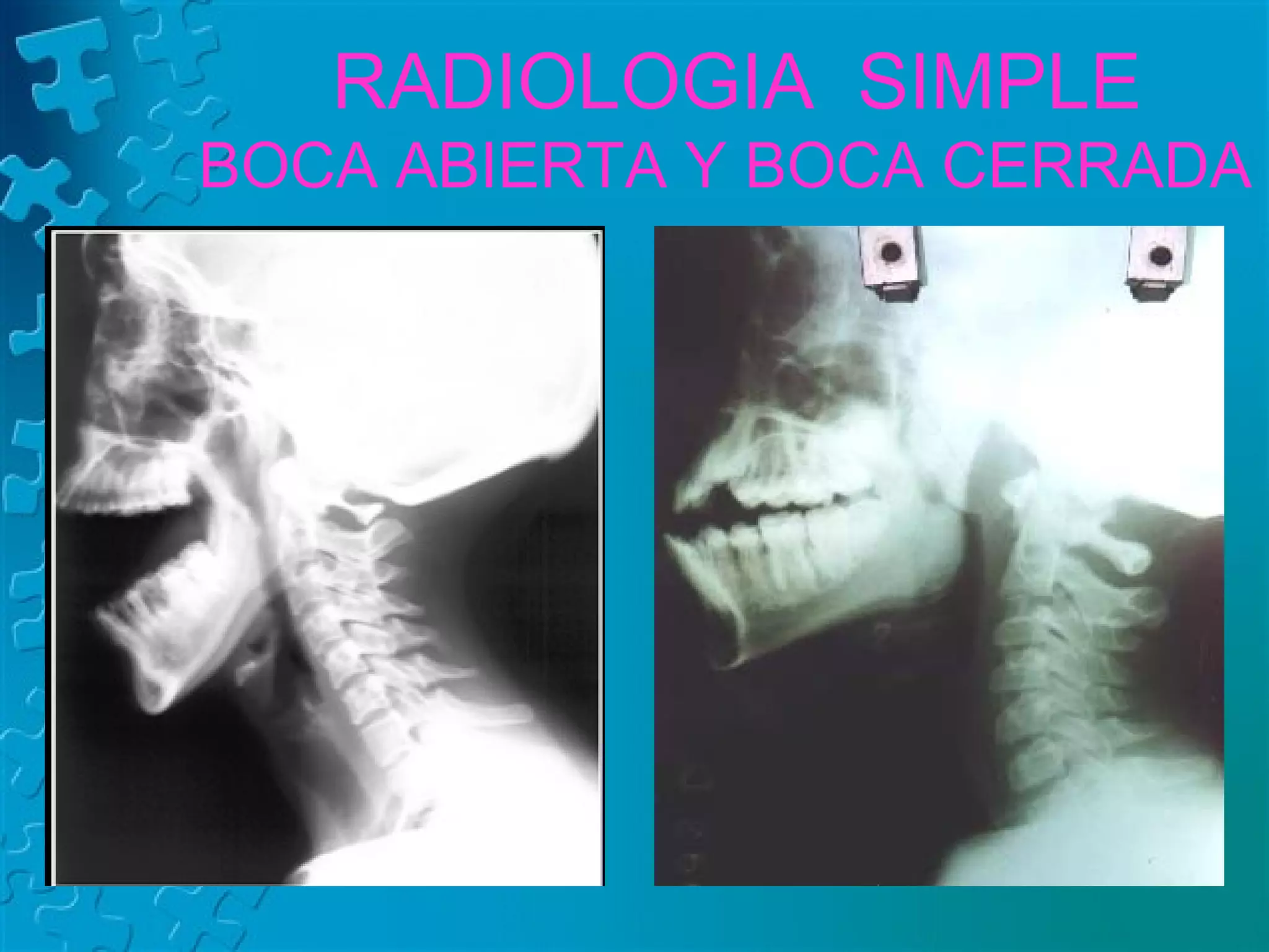 Anatomía Radiológica de Faringe y Laringe | PPT