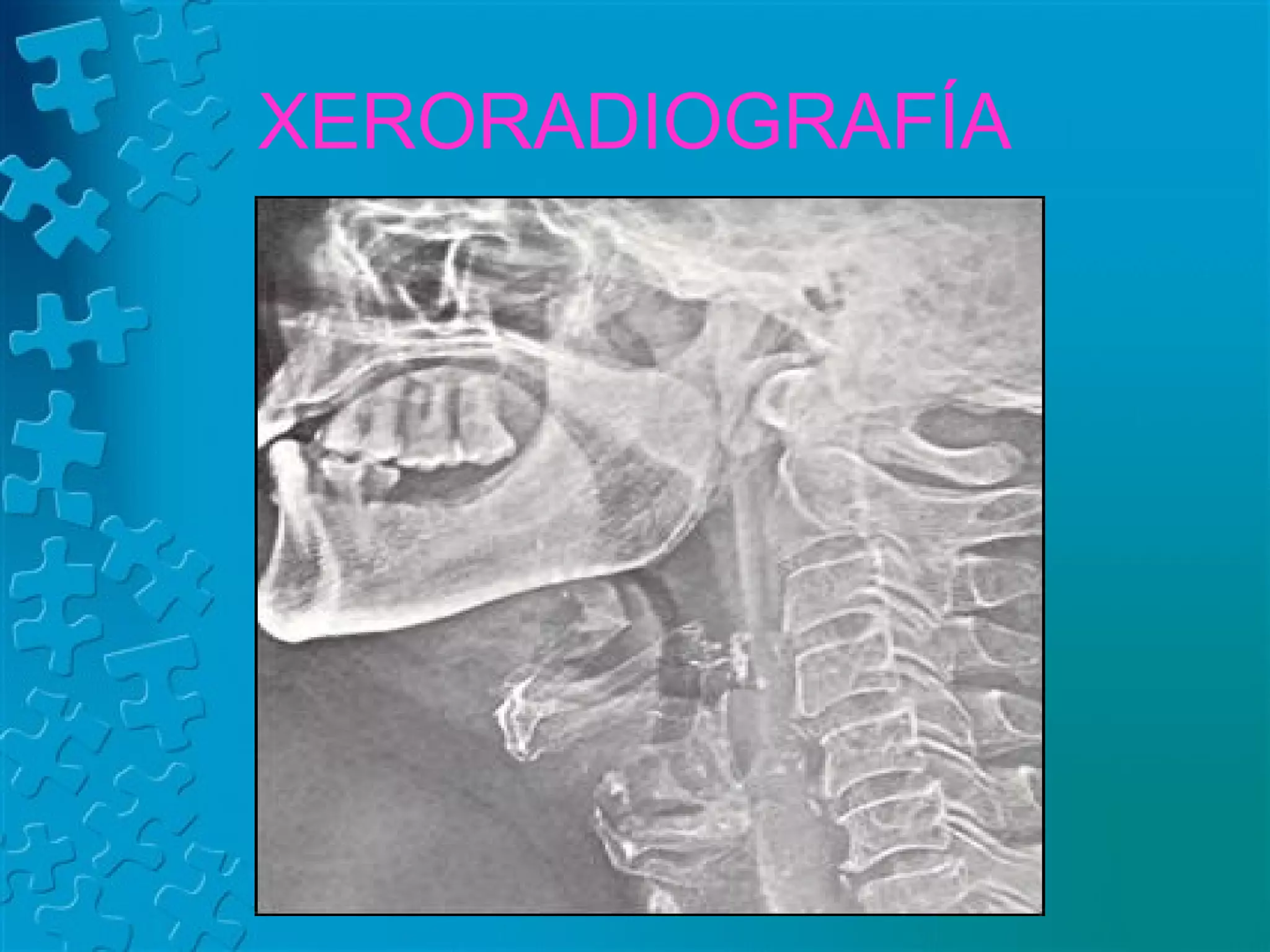 Anatomía Radiológica de Faringe y Laringe | PPT | Ear, Nose and Throat ...