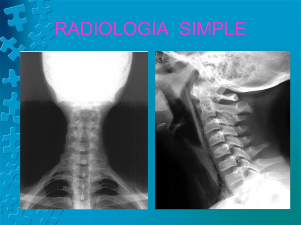Anatomía Radiológica de Faringe y Laringe