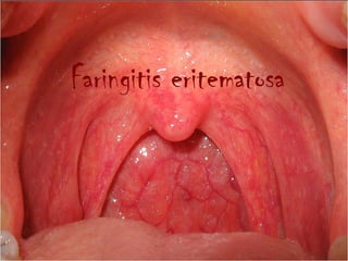 Faringitis eritematosa
 