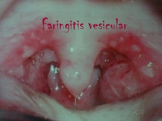 Faringitis vesicular
 