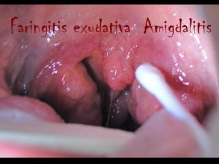 Faringitis exudativa Amigdalitis
 