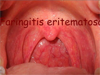 Faringitis eritematosa 