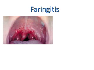 Faringitis 