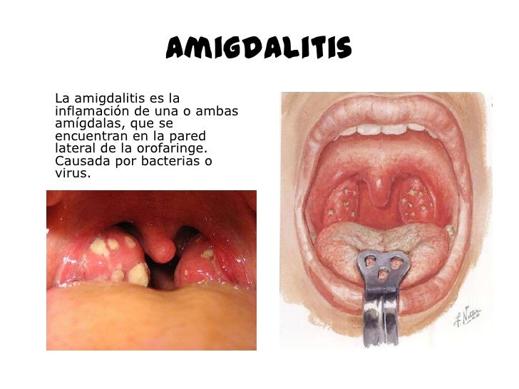 Strep Throat Pictures | Med-Health.net