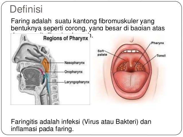Que tomar para faringitis