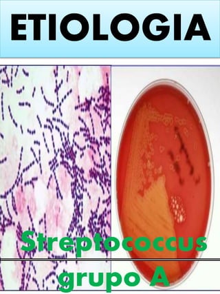 ETIOLOGIA
Streptococcus
grupo A
 