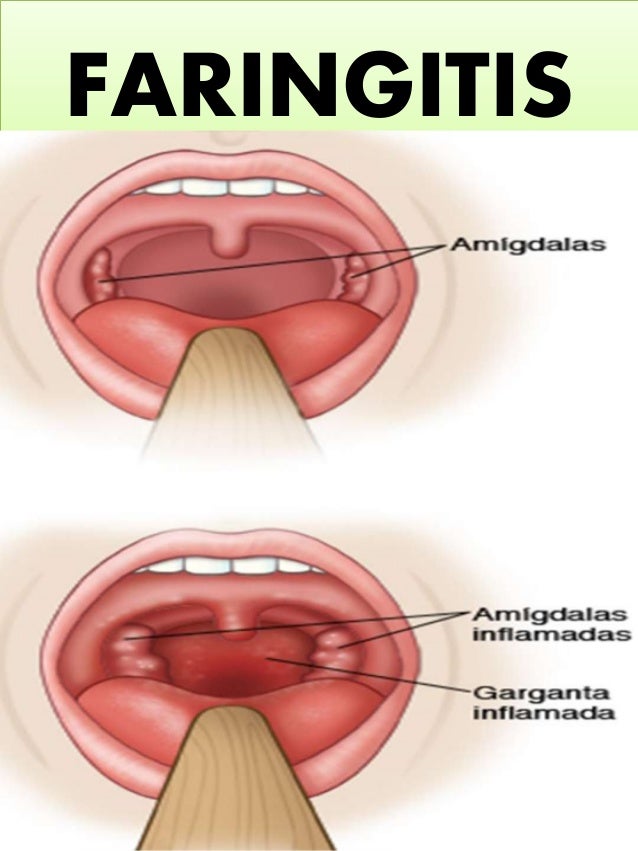 Image result for faringitis
