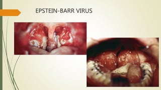 EPSTEIN-BARR VIRUS
 