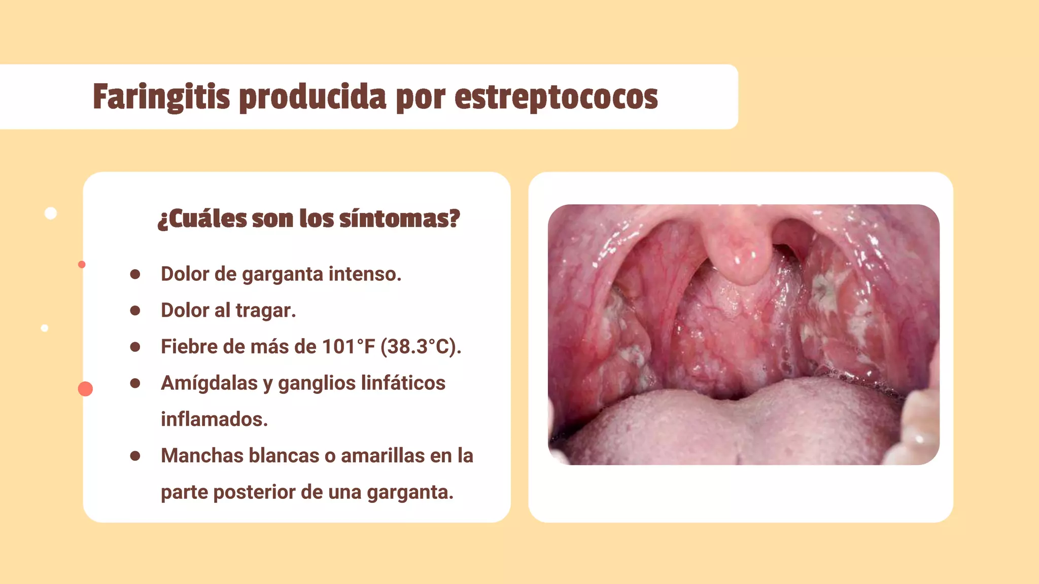 Faringitis | PPTX