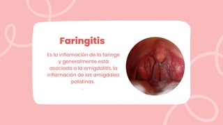 Faringitis
Es la inflamación de la faringe
y generalmente está
asociada a la amigdalitis, la
inflamación de las amígdalas
palatinas.
.
 