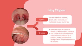Crónica
Aguda
Permanece por mucho más
tiempo, al menos varias semanas.
Sus causas más comunes están
asociadas a los hábitos de la
persona, como pueden ser el
tabaquismo o el consumo crónico
de alcohol.
Hay 2 tipos:
Es una infección a corto
plazo. Está causada por
múltiples virus y bacterias.
 