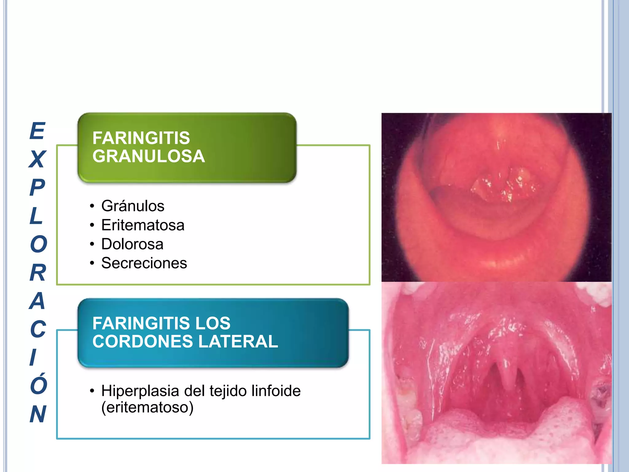 FARINGITIS AGUDA.pptx