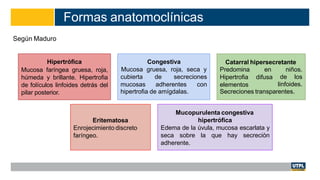 Formas anatomoclínicas
Según Maduro
Hipertrófica
Mucosa faríngea gruesa, roja,
húmeda y brillante. Hipertrofia
de folículos linfoides detrás del
pilar posterior.
Congestiva
Mucosa gruesa, roja, seca y
cubierta de secreciones
mucosas adherentes con
Catarral hipersecretante
en niños.
difusa de los
Predomina
Hipertrofia
elementos linfoides.
hipertrofia de amígdalas. Secreciones transparentes.
Eritematosa
Enrojecimiento discreto
faríngeo.
Mucopurulenta congestiva
hipertrófica
Edema de la úvula, mucosa escarlata y
seca sobre la que hay secreciòn
adherente.
 