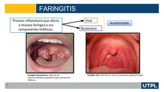 FARINGITIS
5
Proceso inflamatorio que afecta
a mucosa faríngea o sus
componentes linfáticos.
Viral
Bacteriano
Autolimitado
Faringitis estreptocócica. Obtenido de:
https://es.wikipedia.org/wiki/Faringitis_estreptoc%C
3%B3cica
Faringitis viral. Obtenido de: https://es.wikipedia.org/wiki/Faringitis
 
