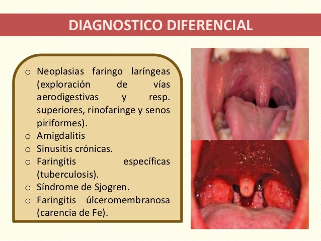 Faringitis Crónica Hiperplásica Granulosa Tratamiento