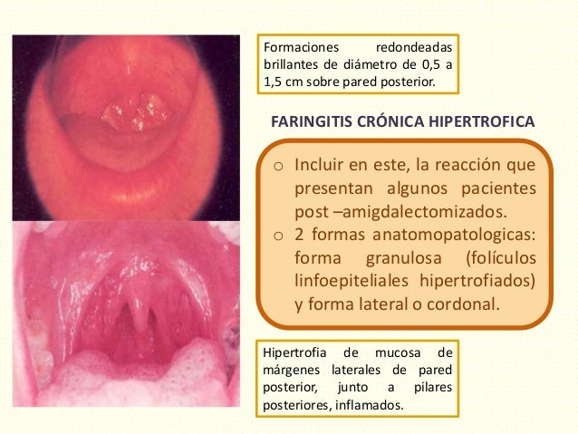 Faringitis crónica
