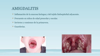 AMIGDALITIS
 Inflamación de la mucosa faríngea y del tejido linfoepitelial adyacente.
 Frecuente en niños de edad prescolar y escolar.
 Invierno y comienzo de la primavera.
 Guarderías.
 