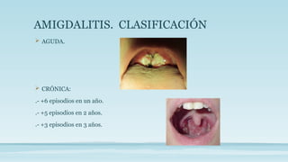 AMIGDALITIS. CLASIFICACIÓN
 AGUDA.
 CRÓNICA:
.- +6 episodios en un año.
.- +5 episodios en 2 años.
.- +3 episodios en 3 años.
 
