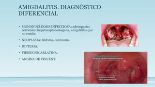 AMIGDALITIS. DIAGNÓSTICO
DIFERENCIAL
• MONONUCLEOSIS INFECCIOSA: adenopatías
cervicales, hepatoesplenomegalia, amigdalitis que
no remite.
• NEOPLASIA: linfoma, carcinoma.
• DIFTERIA.
• FIEBRE ESCARLATINA.
• ANGINA DE VINCENT.
 