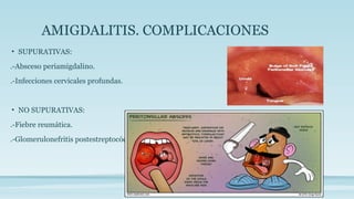 AMIGDALITIS. COMPLICACIONES
• SUPURATIVAS:
.-Absceso periamigdalino.
.-Infecciones cervicales profundas.
• NO SUPURATIVAS:
.-Fiebre reumática.
.-Glomerulonefritis postestreptocócica.
 