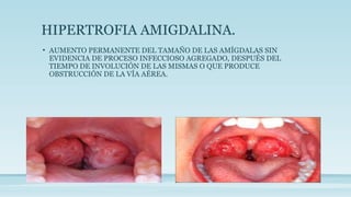 HIPERTROFIA AMIGDALINA.
• AUMENTO PERMANENTE DEL TAMAÑO DE LAS AMÍGDALAS SIN
EVIDENCIA DE PROCESO INFECCIOSO AGREGADO, DESPUÉS DEL
TIEMPO DE INVOLUCIÓN DE LAS MISMAS O QUE PRODUCE
OBSTRUCCIÓN DE LA VÍA AÉREA.
 