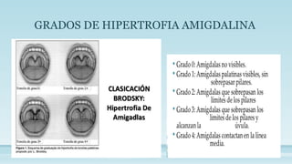 GRADOS DE HIPERTROFIA AMIGDALINA
 