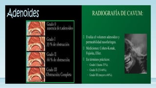 FARINGITIS Y AMIGDALITIS para estudiar.pptx