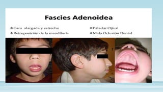 FARINGITIS Y AMIGDALITIS para estudiar.pptx