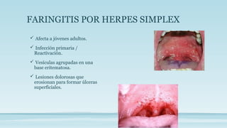 FARINGITIS POR HERPES SIMPLEX
 Afecta a jóvenes adultos.
 Infección primaria /
Reactivación.
 Vesículas agrupadas en una
base eritematosa.
 Lesiones dolorosas que
erosionan para formar úlceras
superficiales.
 