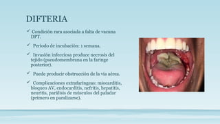 DIFTERIA
 Condición rara asociada a falta de vacuna
DPT.
 Período de incubación: 1 semana.
 Invasión infecciosa produce necrosis del
tejido (pseudomembrana en la faringe
posterior).
 Puede producir obstrucción de la vía aérea.
 Complicaciones extrafaríngeas: miocarditis,
bloqueo AV, endocarditis, nefritis, hepatitis,
neuritis, parálisis de músculos del paladar
(primero en paralizarse).
 