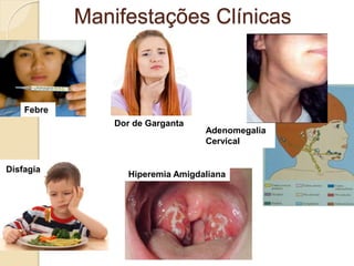 Manifestações Clínicas
Febre
Dor de Garganta
Adenomegalia
Cervical
Disfagia
Hiperemia Amigdaliana
 