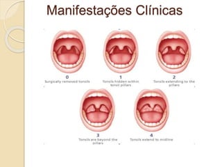 Manifestações Clínicas
 