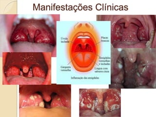 Manifestações Clínicas
 