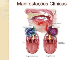 Manifestações Clínicas
 