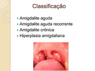  Amigdalite aguda
 Amigdalite aguda recorrente
 Amigdalite crônica
 Hiperplasia amigdaliana
Classificação
 