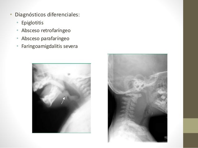 Amoxicilina dosis niños 3 años Amoxicilina dosis niños 3 años