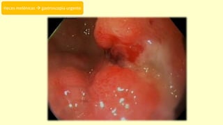 Heces melénicas  gastroscopia urgente
 