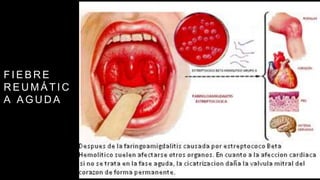 F I E B R E
R E U M Á T I C
A A G U D A
 