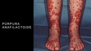 P Ú R P U R A
A N A F I L A C T O I D E
 