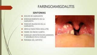 FARINGOAMIGDALITIS
SINTOMAS
 DOLOR DE GARGANTA
 ENROGECIMIENTO DE LA
GARGANTA
 PARCHES BLANCOS EN LA
GARGANTA .
 DIFICULTADA PARA DEGLUTIR.
 FIEBRE DE INICIO SUBITO.
 GANGLIO LINFATICOS INFLAMADOS
Y SENSIBLES EN EL CUELLO
 PERDIDA DEL APETITO
 