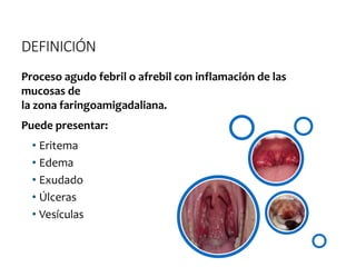 DEFINICIÓN
Proceso agudo febril o afrebil con inflamación de las
mucosas de
la zona faringoamigadaliana.
Puede presentar:
• Eritema
• Edema
• Exudado
• Úlceras
• Vesículas
 