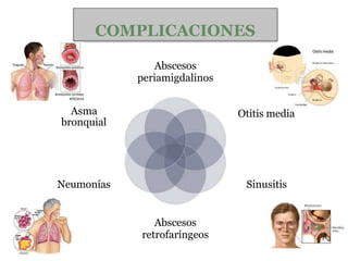 COMPLICACIONES
Abscesos
periamigdalinos
Otitis media
Sinusitis
Abscesos
retrofaríngeos
Neumonías
Asma
bronquial
 