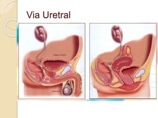 Via Uretral
 