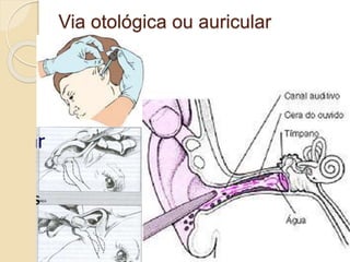 Via otológica ou auricular
 