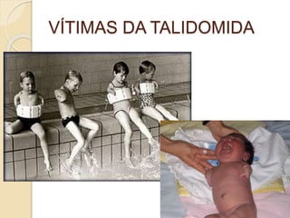 VÍTIMAS DA TALIDOMIDA
 