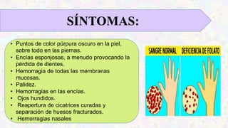 SÍNTOMAS:
• Puntos de color púrpura oscuro en la piel,
sobre todo en las piernas.
• Encías esponjosas, a menudo provocando la
pérdida de dientes.
• Hemorragia de todas las membranas
mucosas.
• Palidez.
• Hemorragias en las encías.
• Ojos hundidos.
• Reapertura de cicatrices curadas y
separación de huesos fracturados.
• Hemorragias nasales
 