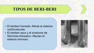• El beriberi húmedo: Afecta el sistema
cardiovascular.
• El beriberi seco y el síndrome de
Wernicke-Kórsakov: Afectan el
sistema nervioso.
TIPOS DE BERI-BERI
 