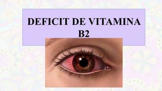 DEFICIT DE VITAMINA
B2
 